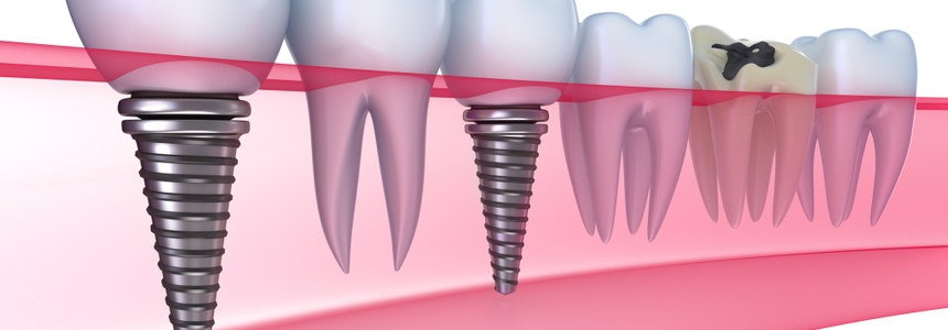 Diagram of dental implants