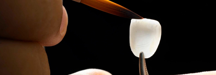 Dental veneer being touched up