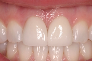 periodontal trauma repaired