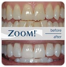 Zoom teeth whitening