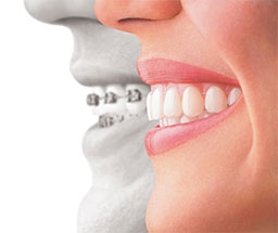 invisalign vs conventional braces