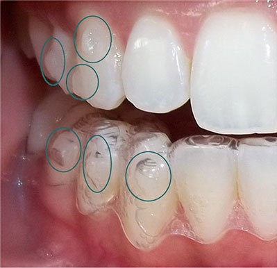 Patient Story: The Invisalign Installation Process