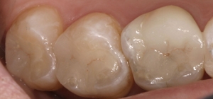 amalgam replaced with composite