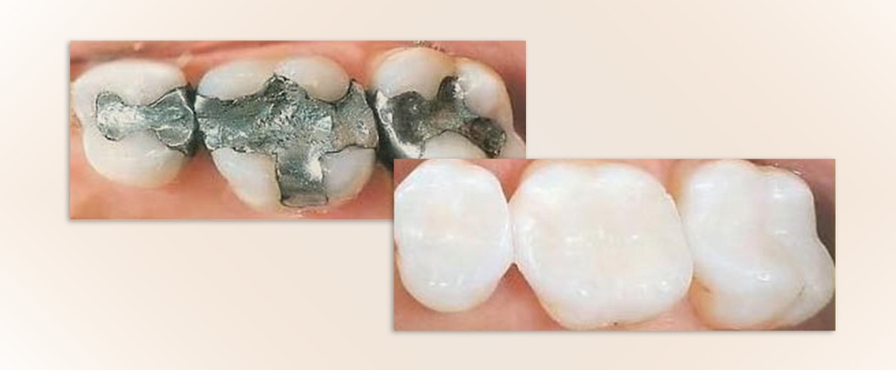 white tooth-colored composite fillings