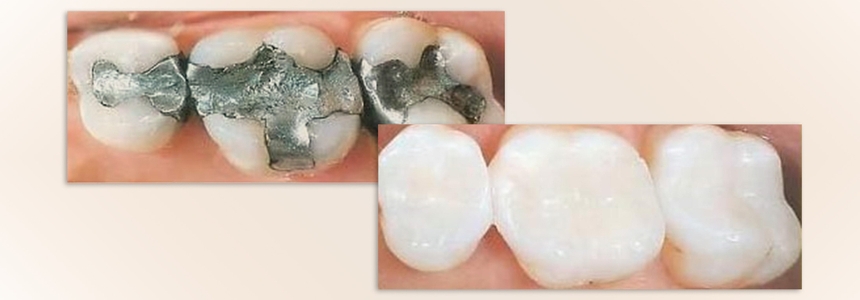 Composite fillings vs metal amalgam