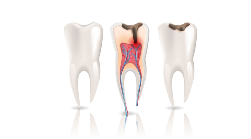 root canal treatment near me
