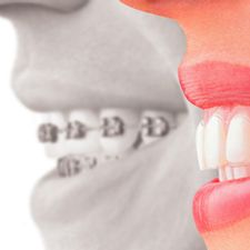 Invisalign versus braces