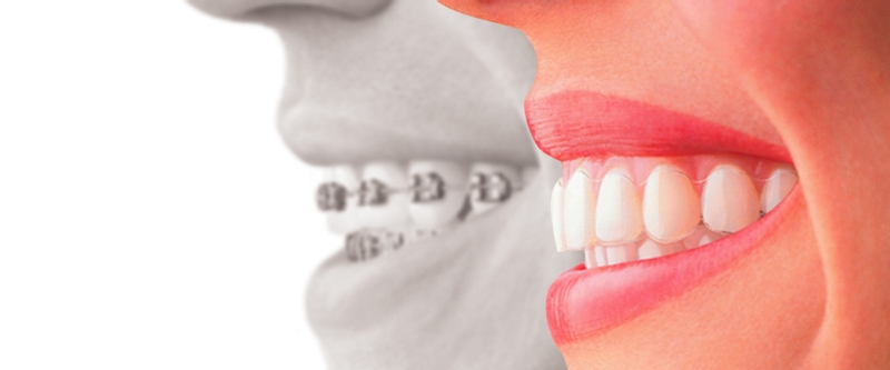 Invisalign versus braces