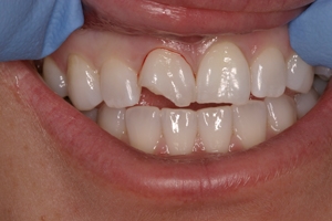 periodontal trauma