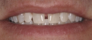 undesired space between front teeth