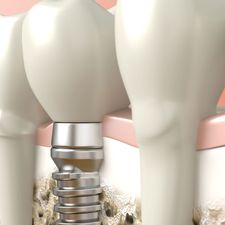 illustration of implant post and crown