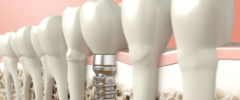 illustration of implant post and crown