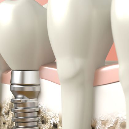 illustration of implant post and crown