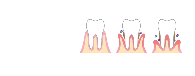 Diagram of receding gum progression