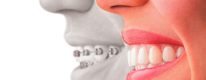 Invisalign versus traditional braces