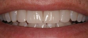 space closed with veneers