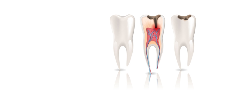 Diagram of root canal infection